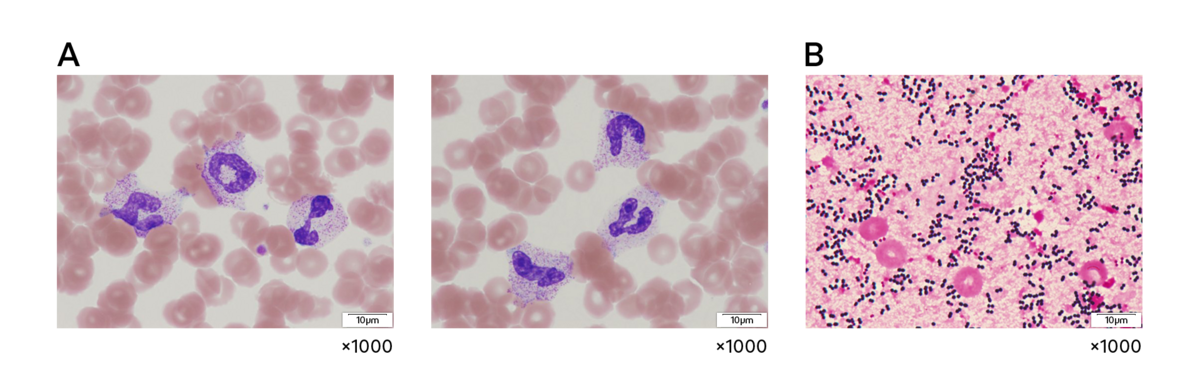 Abb. 3 (A) Der periphere Blutausstrich des Patienten zeigte eine toxische Granulation von Neutrophilen. (B) Die Blutkultur (Gramfärbung) wurde positiv auf Staphylococcus aureus getestet.