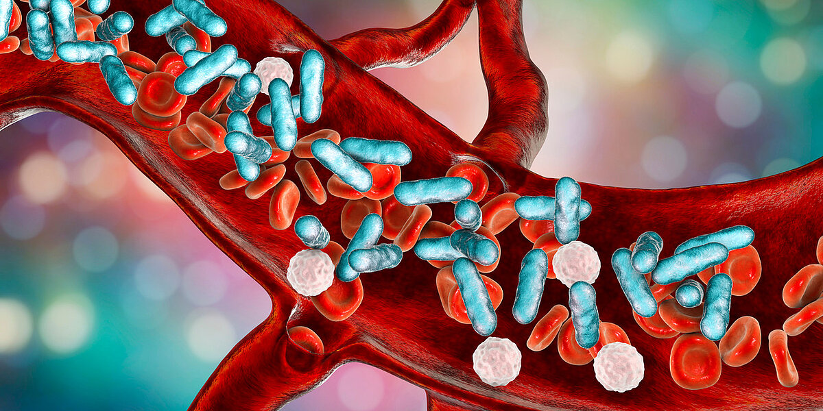 Sepsis Sepsis
