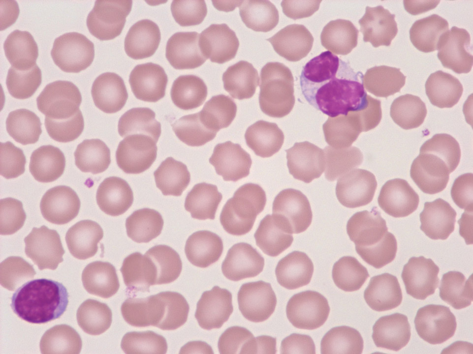 Atypischer Lymphozyt Atypischer Lymphozyt