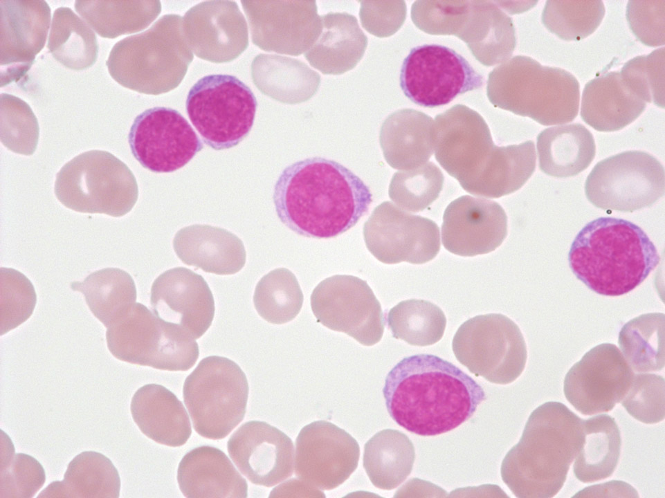 Prolymphoyzten und Lymphozyten Prolymphoyzten und Lymphozyten