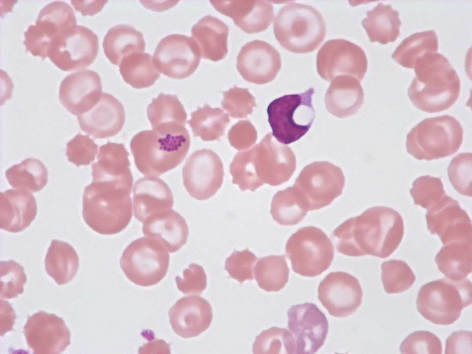 Streptokokken-Septikämie Streptokokken-Septikämie