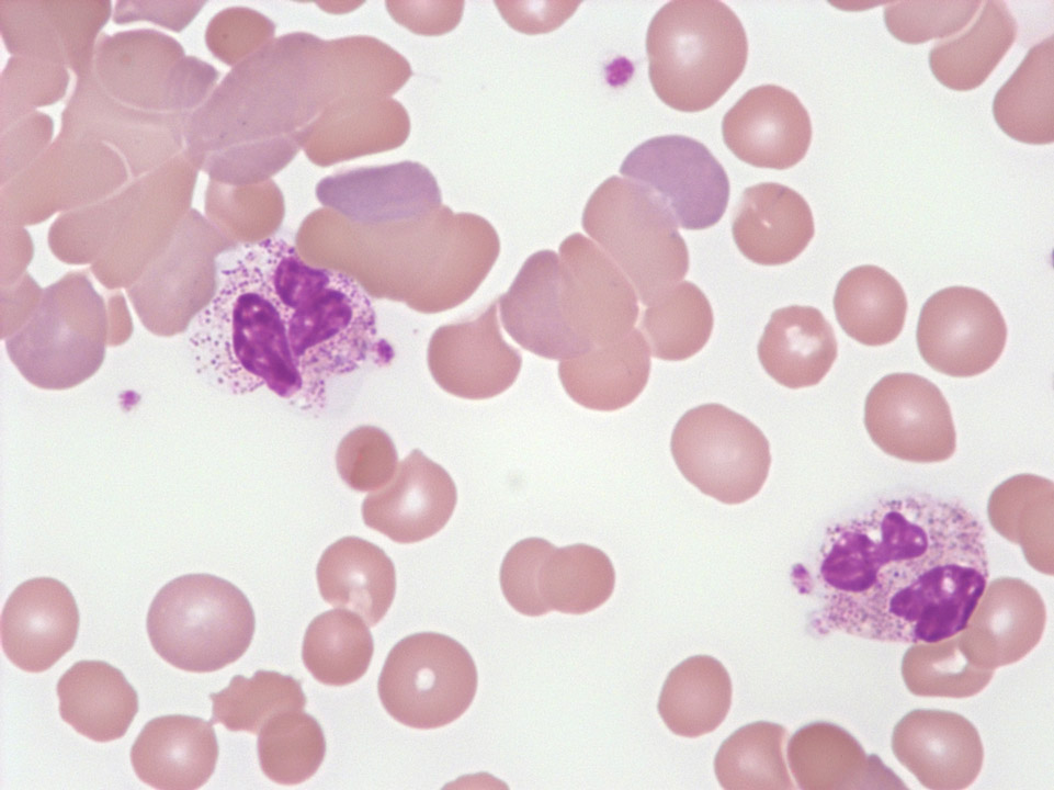 Rouleaux-Bildung und Verklumpung, Kälteagglutination Rouleaux-Bildung und Verklumpung, Kälteagglutination