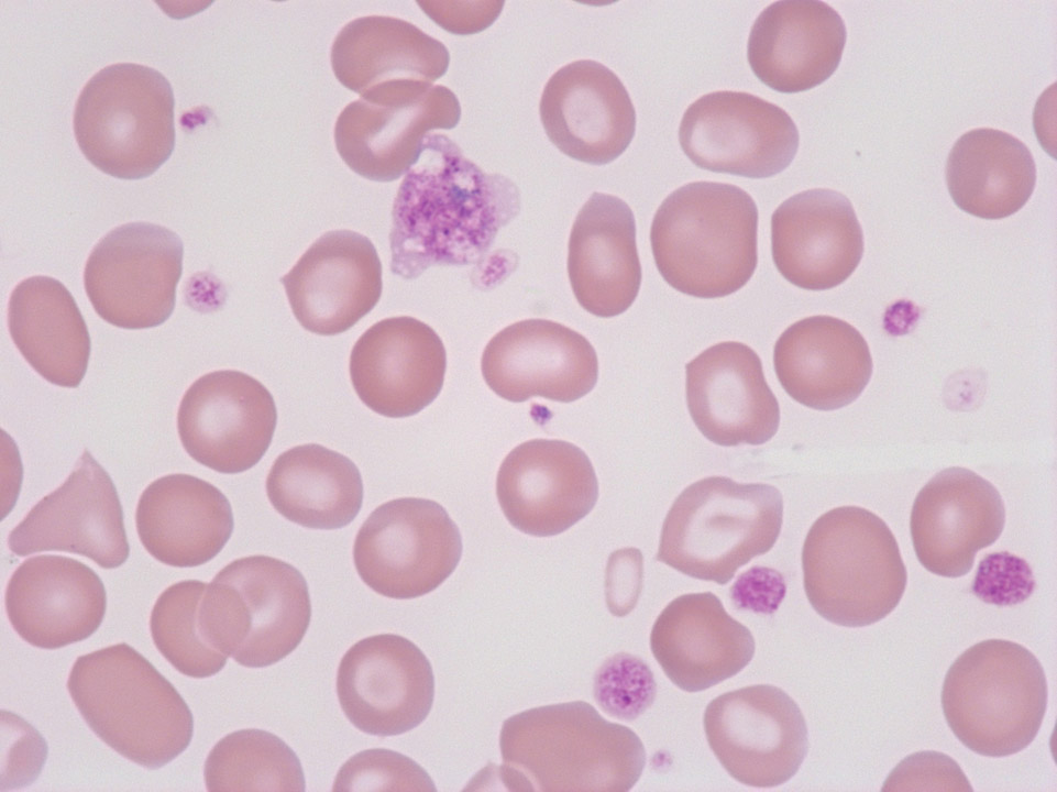 Riesenthrombozyt, essentielle Thrombozythämie (ET) Riesenthrombozyt, essentielle Thrombozythämie (ET)
