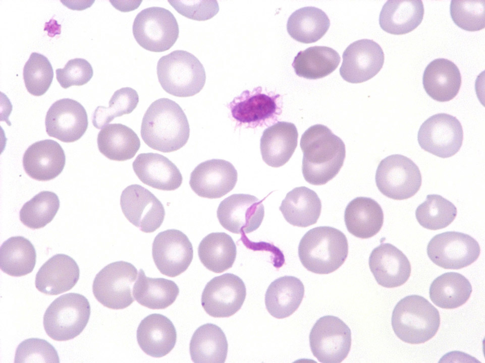 Anomale Thrombozyten; MDS Anomale Thrombozyten; MDS