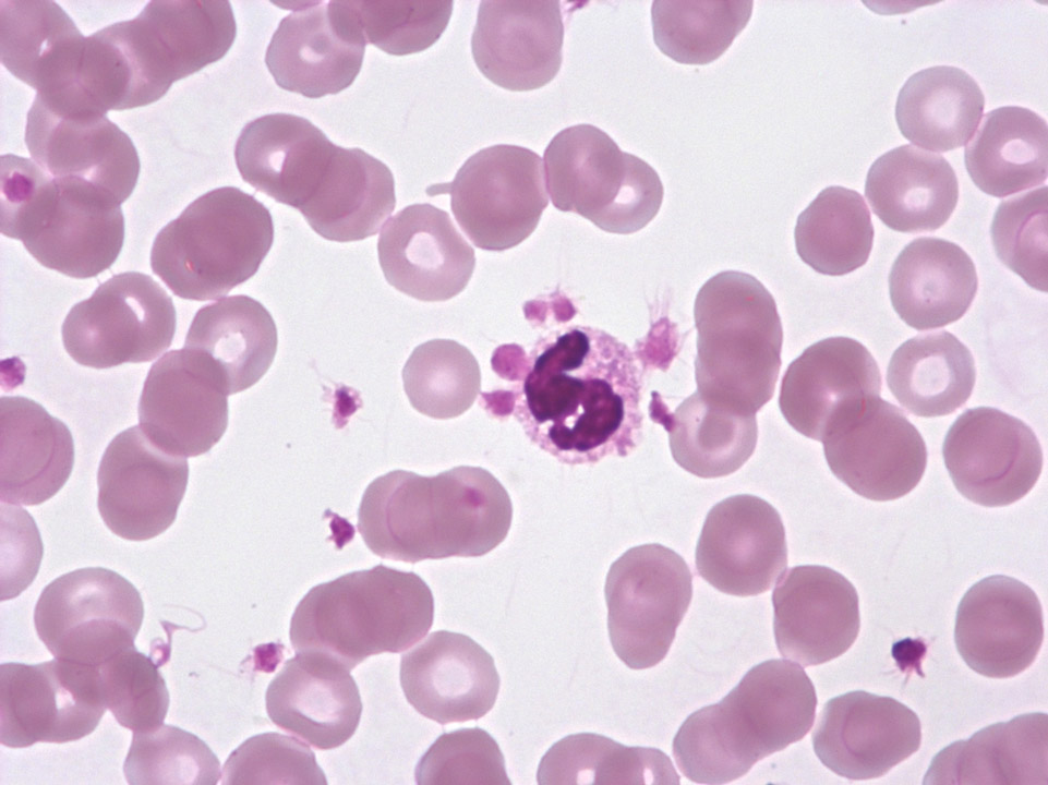 Ansammlung von Thrombozyten an Granulozyten Ansammlung von Thrombozyten an Granulozyten