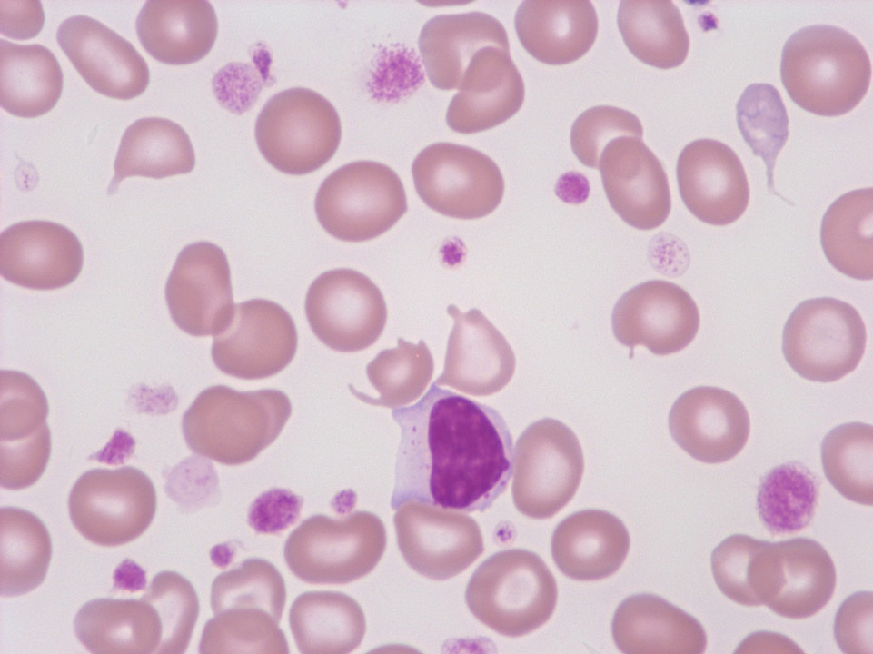 Thrombozytose, Anisozytose der Thrombozyten und Riesenthrombozyten Thrombozytose, Anisozytose der Thrombozyten und Riesenthrombozyten