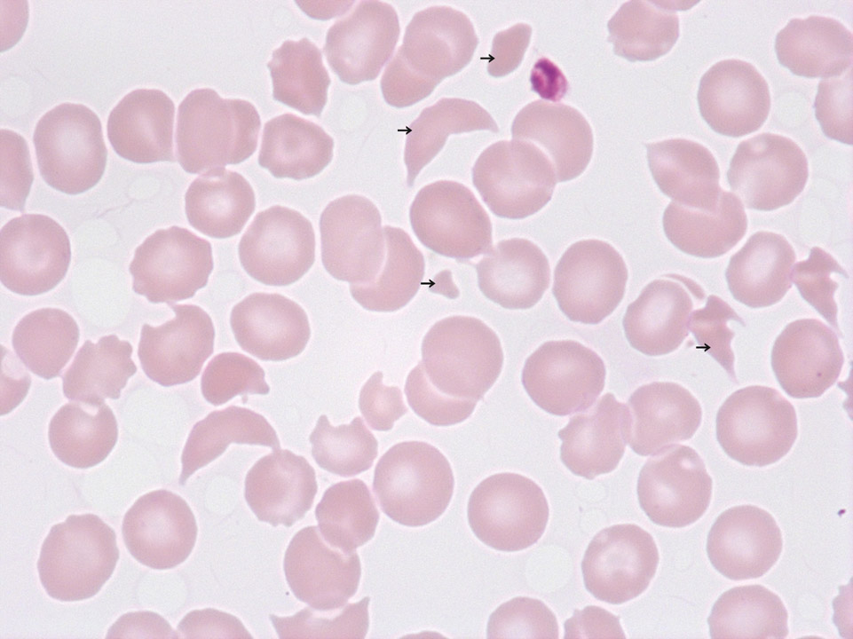 Schistozyten und Thrombozytopenie, HUS Schistozyten und Thrombozytopenie, HUS