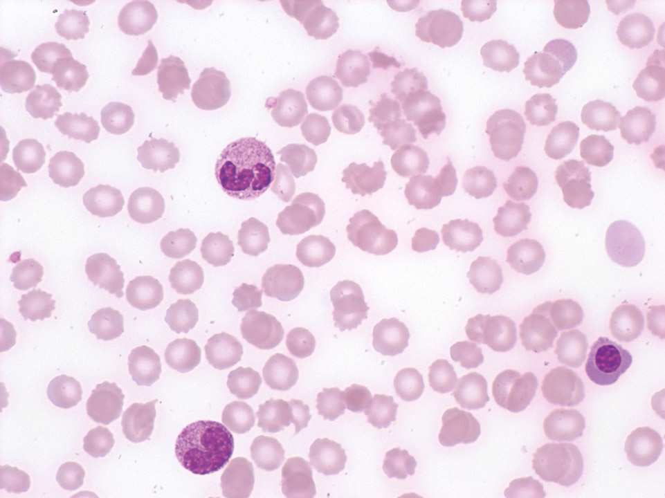 Leukoerythroblastisches Blutbild und Schistozyten Leukoerythroblastisches Blutbild und Schistozyten