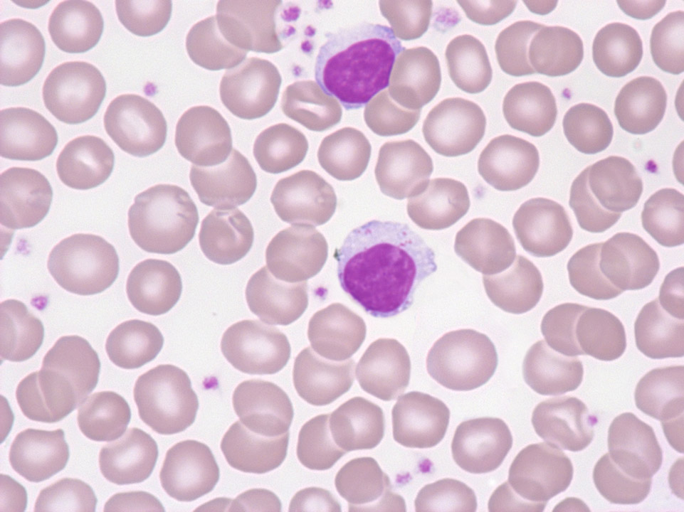 T-Zell-Leukämie großer granulärer Lymphozyten (T-LGL-Leukämie) T-Zell-Leukämie großer granulärer Lymphozyten (T-LGL-Leukämie)