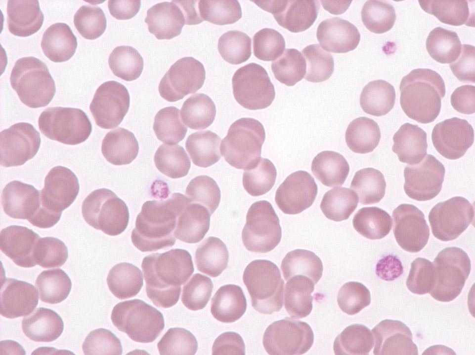 Thrombozytopenie und Anisozytose der Thrombozyten Thrombozytopenie und Anisozytose der Thrombozyten