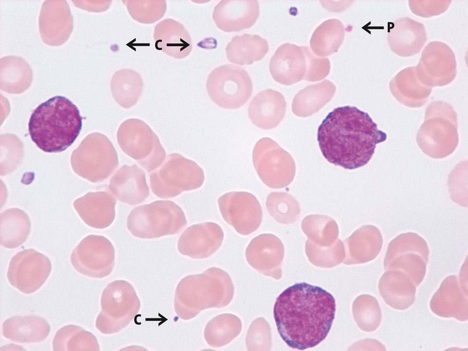 Thrombozytopenie und Nachweis von Zytoplasmafragmenten aus Monoblasten, AML-M5a Thrombozytopenie und Nachweis von Zytoplasmafragmenten aus Monoblasten, AML-M5a