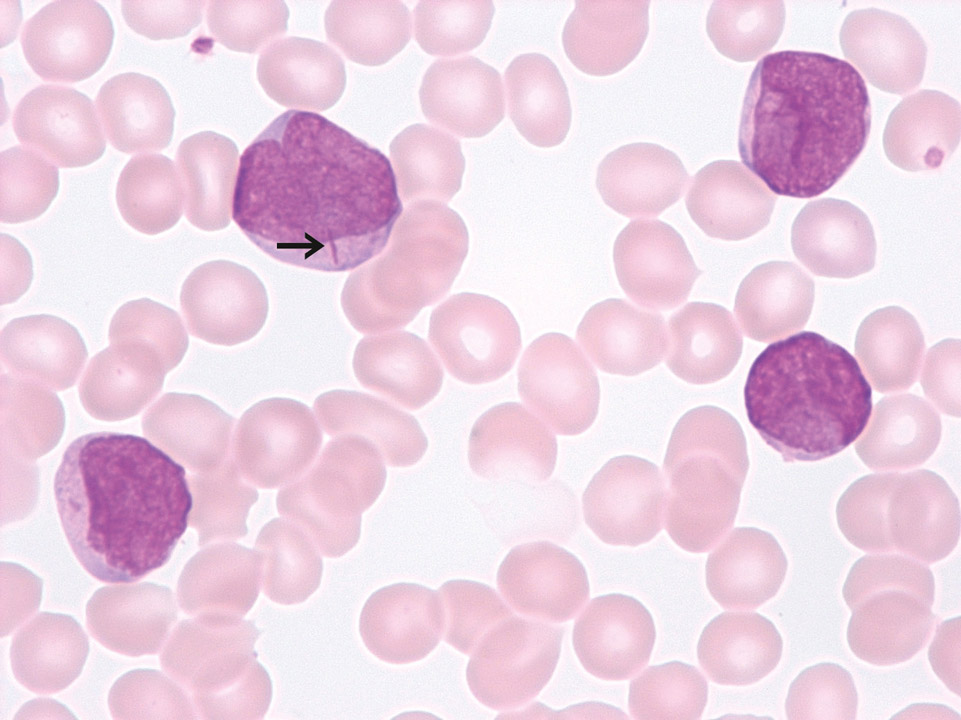Auer-Stäbchen im Zytoplasma von Myeloblasten Auer-Stäbchen im Zytoplasma von Myeloblasten