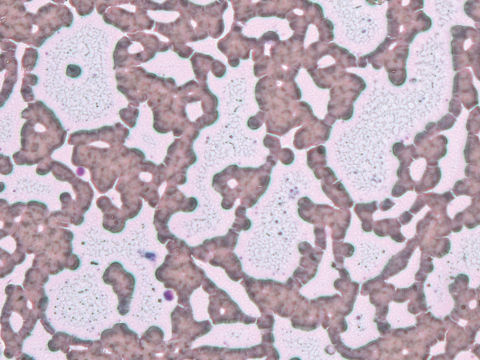 Phasenkontrastmikroskopie, ausgeflocktes Kryoglobulin Phasenkontrastmikroskopie, ausgeflocktes Kryoglobulin