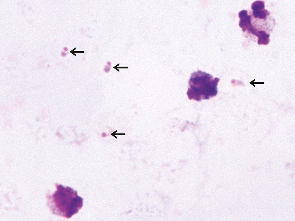 Malaria: Dicker Tropfen mit hoher Malariaerregerdichte Malaria: Dicker Tropfen mit hoher Malariaerregerdichte