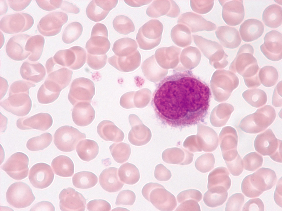 Primäre Myelofibrose (PMF) Primäre Myelofibrose (PMF)