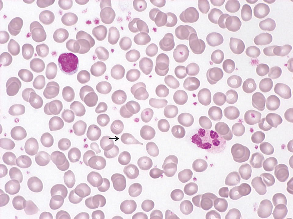 Primäre Myelofibrose (PMF), präfibrotische Phase Primäre Myelofibrose (PMF), präfibrotische Phase