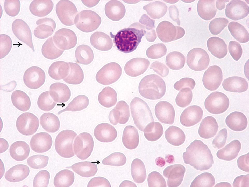 Primäre Myelofibrose (PMF), fibrotische Phase Primäre Myelofibrose (PMF), fibrotische Phase