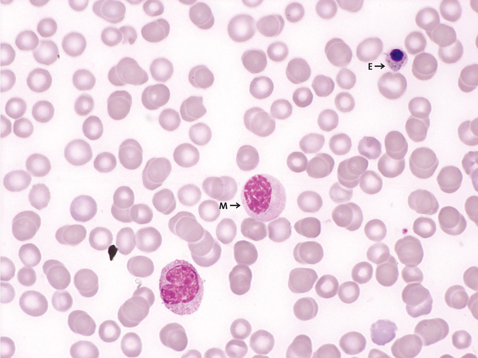 Peripherer Blutausstrich, Patient mit Mammakarzinom und Knochenmetastasen Peripherer Blutausstrich, Patient mit Mammakarzinom und Knochenmetastasen