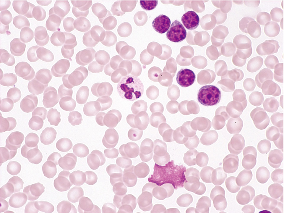 Peripherer Blutausstrich, typische B-CLL Peripherer Blutausstrich, typische B-CLL