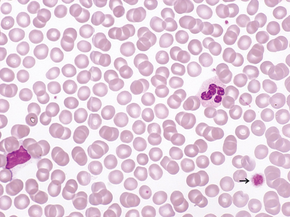 Peripherer Blutausstrich, Patient mit B-CLL Peripherer Blutausstrich, Patient mit B-CLL
