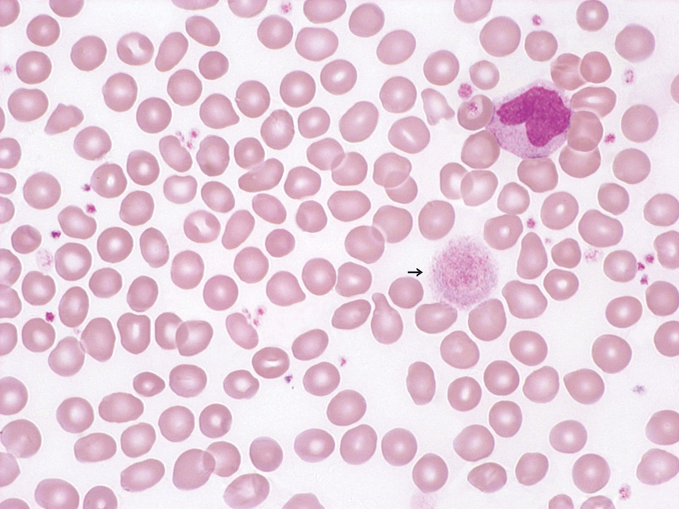 Riesenthrombozyten im peripheren Blut Riesenthrombozyten im peripheren Blut