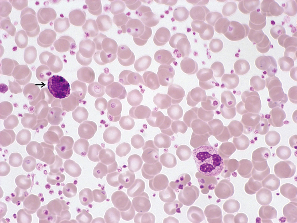 Peripherer Blutausstrich, Patient mit CML Peripherer Blutausstrich, Patient mit CML