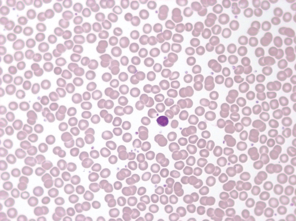 Peripherer Blutausstrich, Patient mit isolierter Neutropenie Peripherer Blutausstrich, Patient mit isolierter Neutropenie