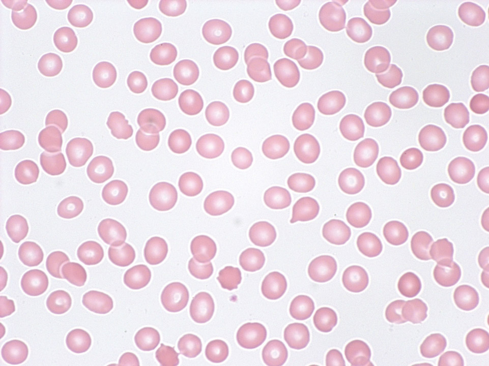 Panzytopenie (Trizytopenie) im peripheren Blut Panzytopenie (Trizytopenie) im peripheren Blut