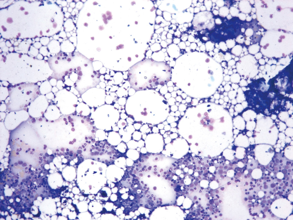 Knochenmarkzytologie, Patient mit aplastischer Anämie Knochenmarkzytologie, Patient mit aplastischer Anämie