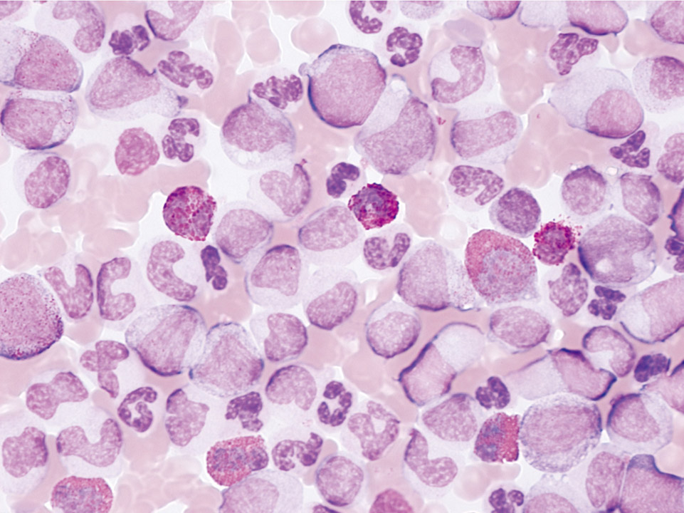 Peripherer Blutausstrich, Patient mit CML Peripherer Blutausstrich, Patient mit CML