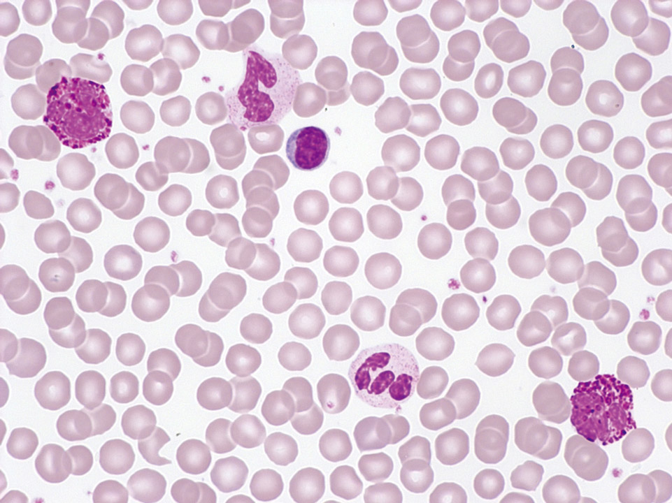 Peripherer Blutausstrich, Patient mit CML Peripherer Blutausstrich, Patient mit CML