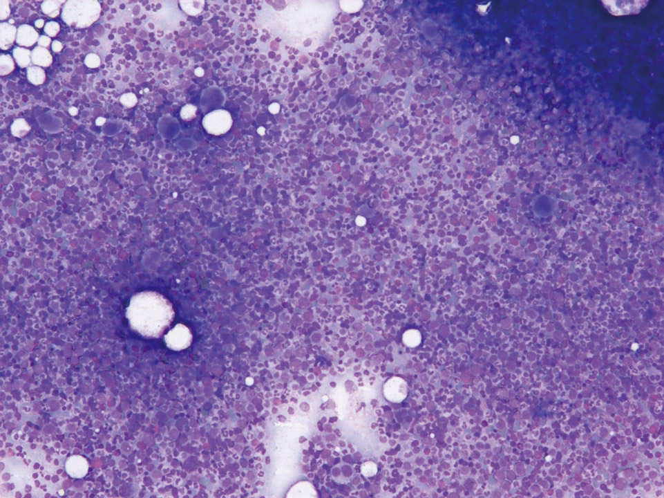 Knochenmarkzytologie, Patient mit CML Knochenmarkzytologie, Patient mit CML
