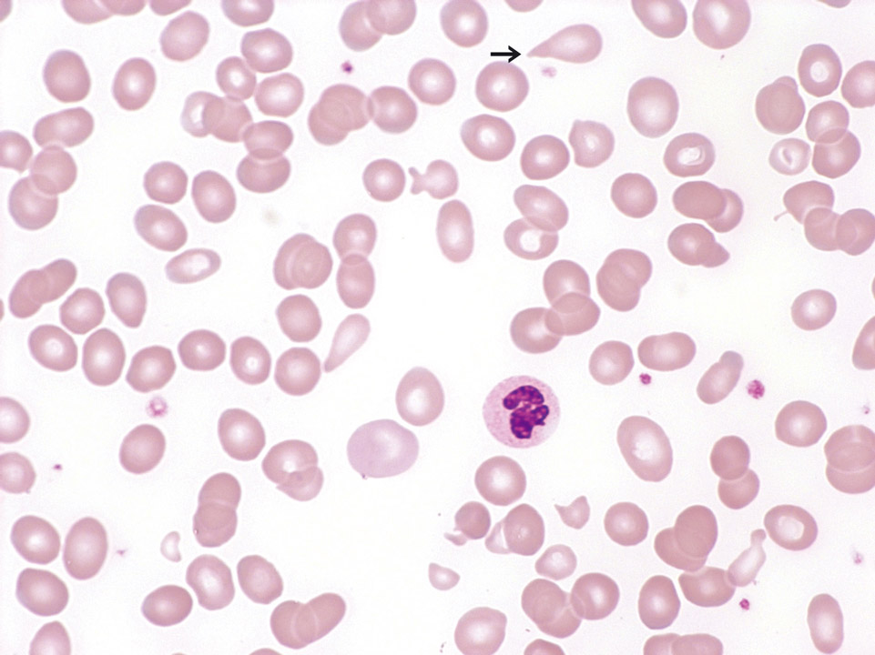 Makrozytäre, hyporegenerative Anämie Makrozytäre, hyporegenerative Anämie