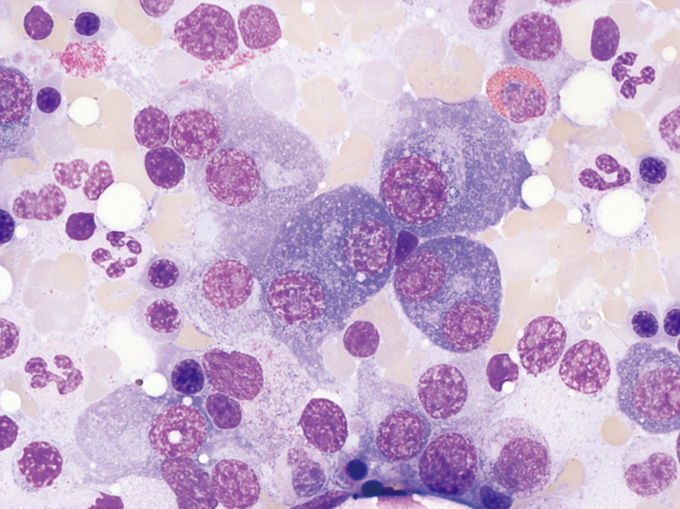 Knochenmarkzytologie, Patient mit multiplem Myelom Knochenmarkzytologie, Patient mit multiplem Myelom