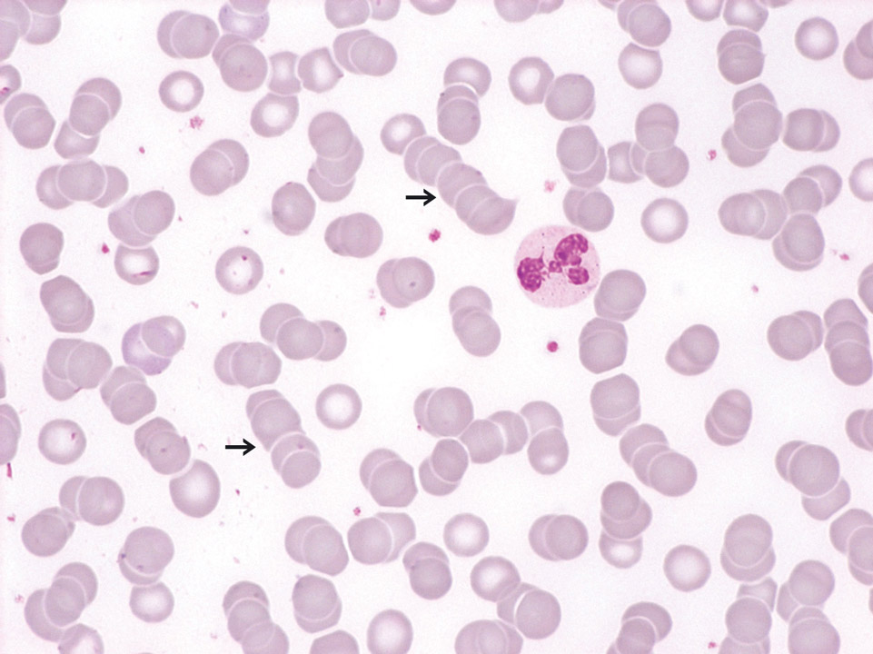 Rouleaux-Bildung der Erythrozyten Rouleaux-Bildung der Erythrozyten