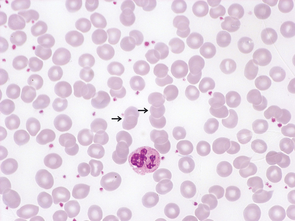 Rouleaux-Bildung im Blut, Patient mit chronischer Polyarthritis Rouleaux-Bildung im Blut, Patient mit chronischer Polyarthritis