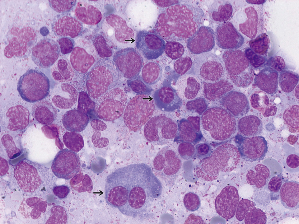 Knochenmarkzytologie, Patient mit CMML Knochenmarkzytologie, Patient mit CMML