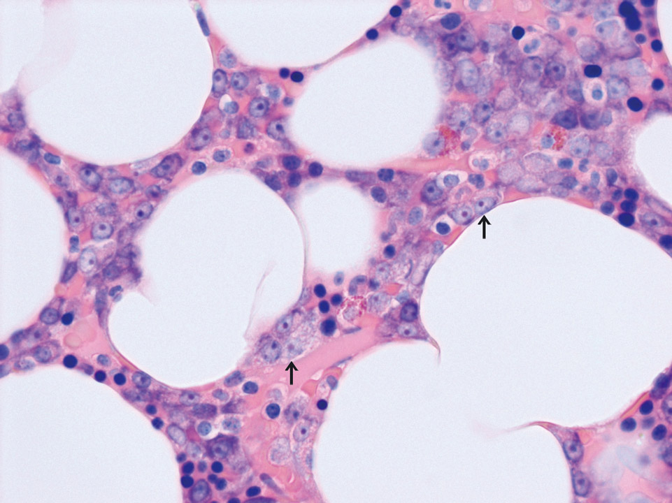 Plasmazellen im Knochenmark, Patient mit multiplem Myelom