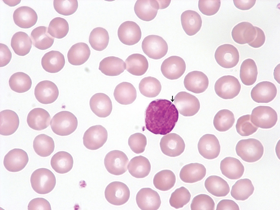 Lymphomzellen im peripheren Blut Lymphomzellen im peripheren Blut