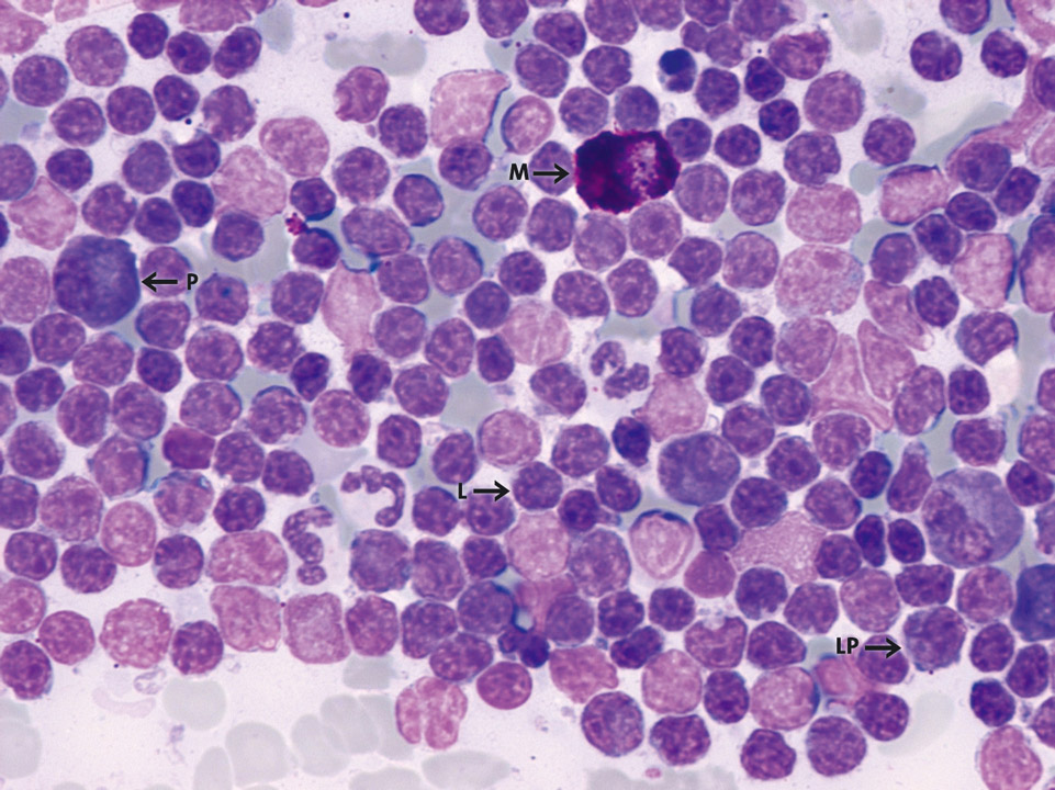 Knochenmarkzytologie, Patient mit Immunozytom Knochenmarkzytologie, Patient mit Immunozytom