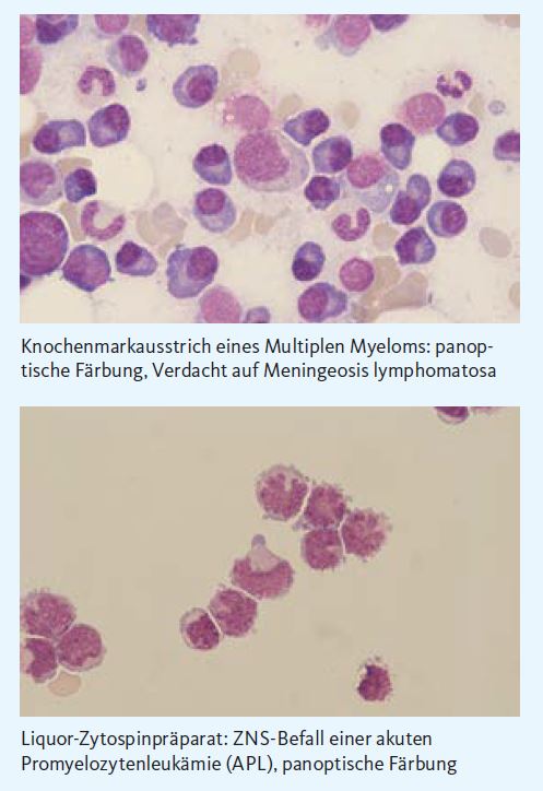 Erkenntnisse aus Knochenmark und Liquor