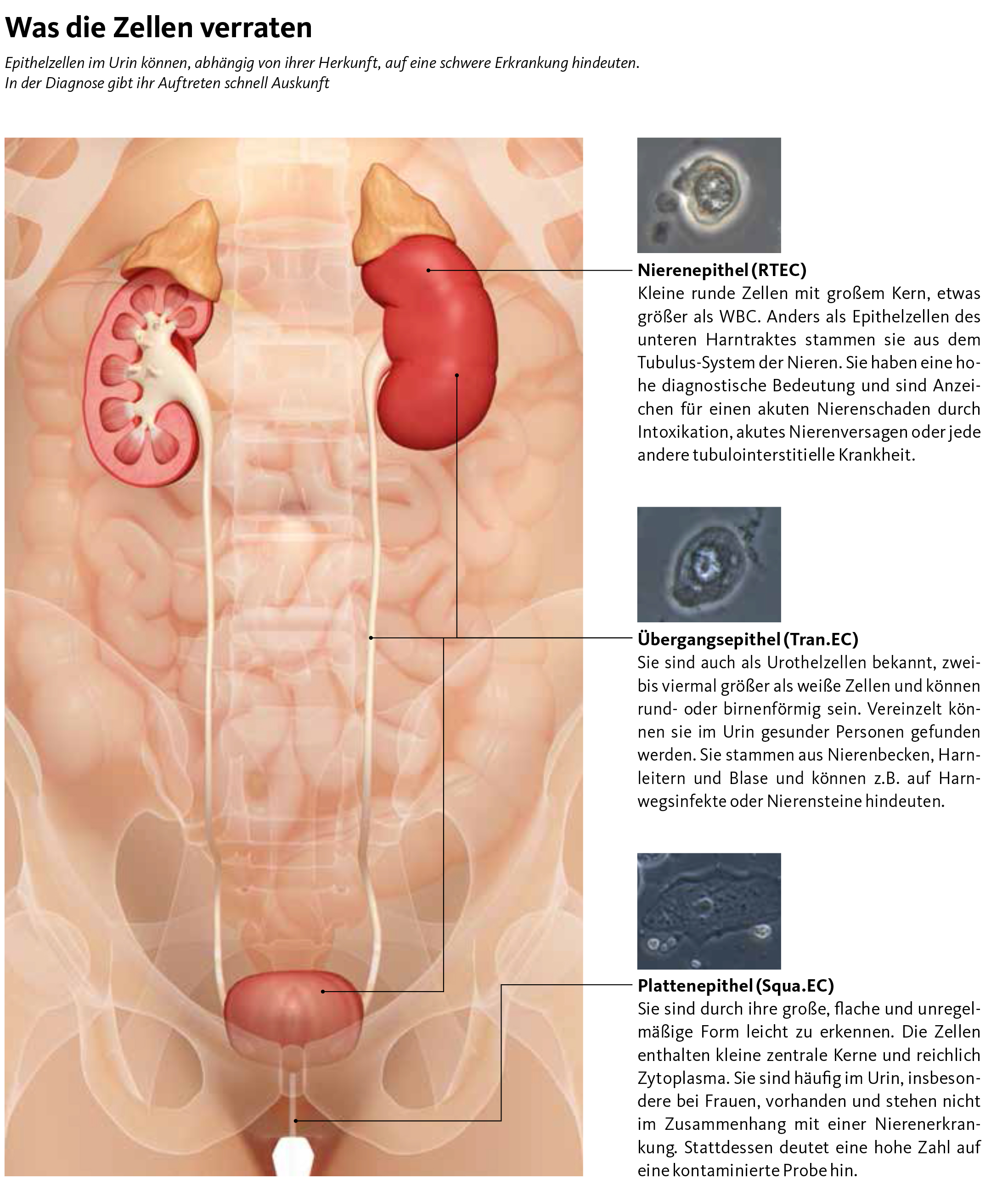 Plattenepithelien urin plattenepithelien